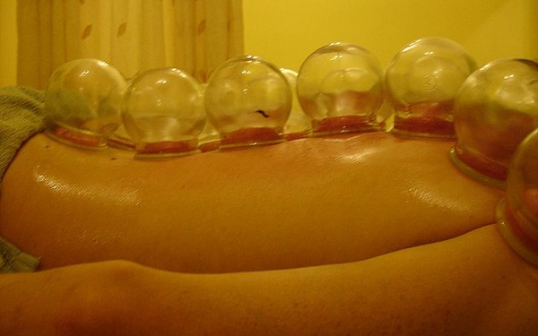 cupping therapy in bangkok